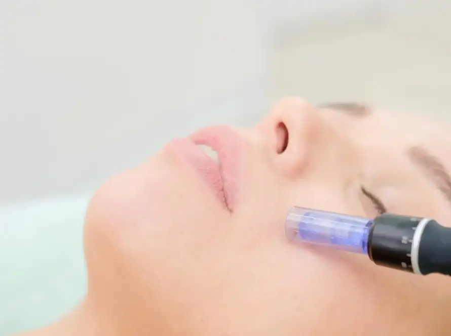 A client receiving a professional microneedling treatment to boost collagen glow at Xthetics Med Spa.