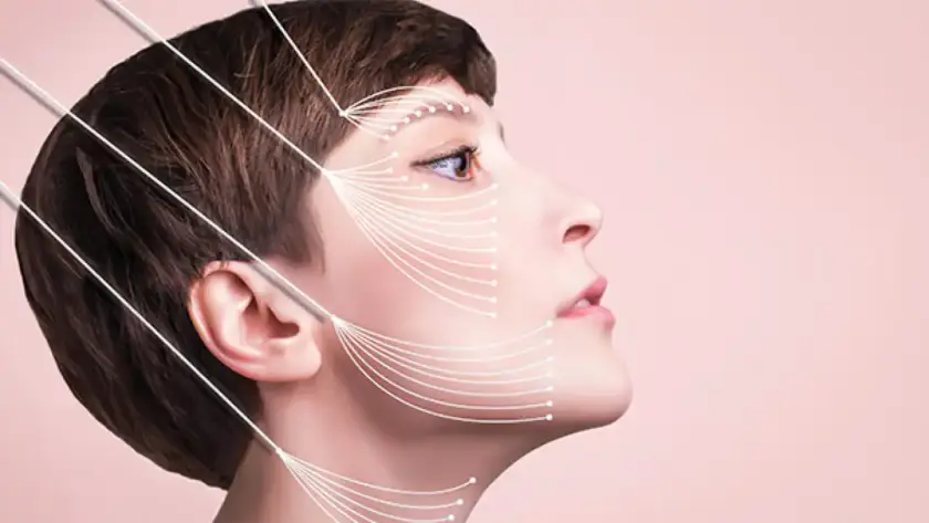 Side profile diagram showing non-surgical PDO Thread Lift vectors at Xthetics Med Spa.